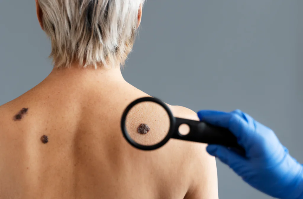 Zdjęcie przedstawiające pieprzyki rakowe na skórze kobiety